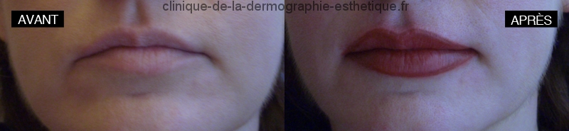 Maquillage permanent - coloration des lèvres