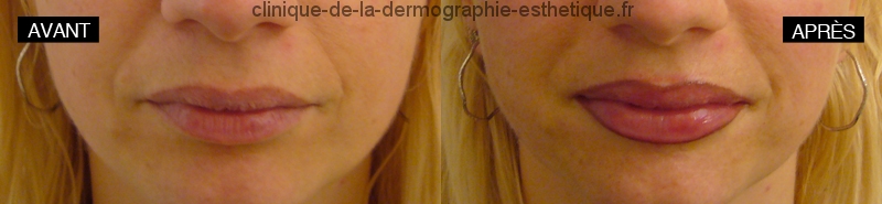 Maquillage permanent - Contour des lèvres