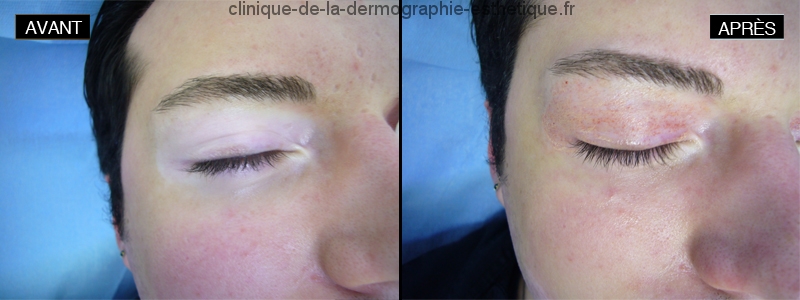 Dermographie réparatrice - Vitiligo (Corrective dermography - Vitiligo)
